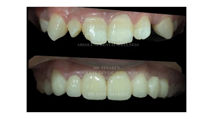 Smile Transformation 3